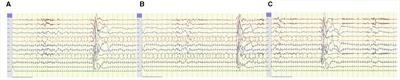 Utility and limitations of EEG in the diagnosis and management of ALDH7A1-related pyridoxine-dependent epilepsy. A retrospective observational study